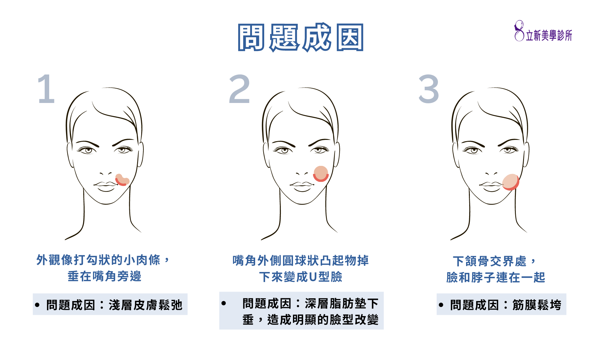 問題成因 外觀像打勾狀的小肉條，垂在嘴邊旁邊 問題成因:淺層皮膚鬆弛 嘴角外側圓球狀凸起物掉下來變成U型臉 問題成因:深層脂肪墊下垂，造成明顯的臉型改變 下頷骨交界處，臉和脖子連在一起 問題成因:筋膜鬆垮